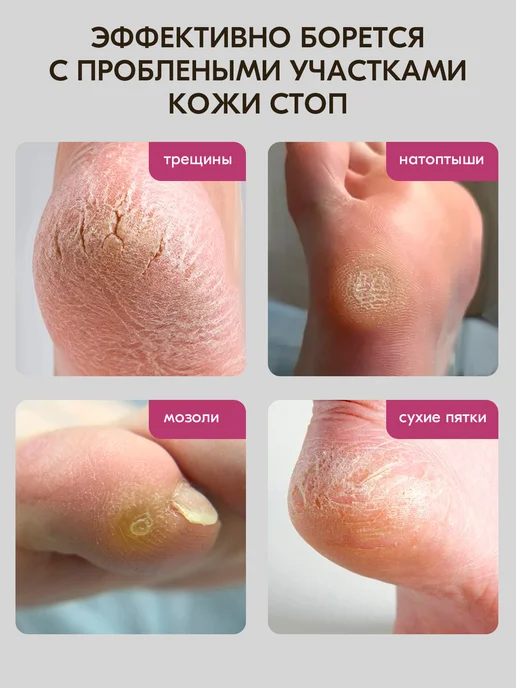 INKI Размягчитель для пяток, мозолей и натоптышей деликатный, вариант, фото 5