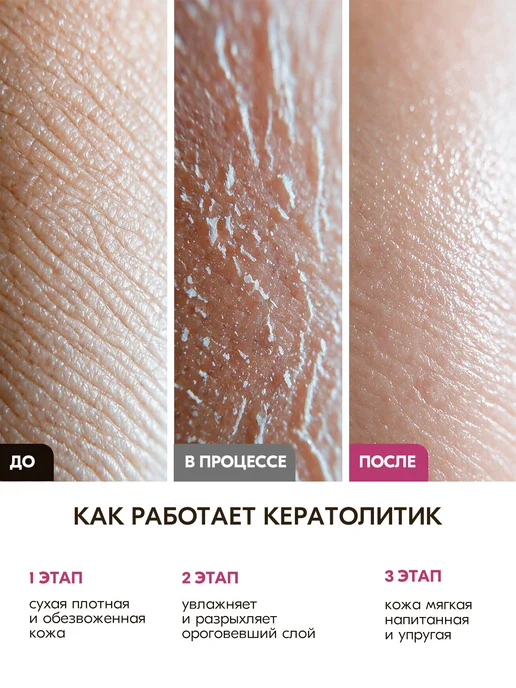 INKI Размягчитель для пяток, мозолей и натоптышей деликатный, вариант, фото 7