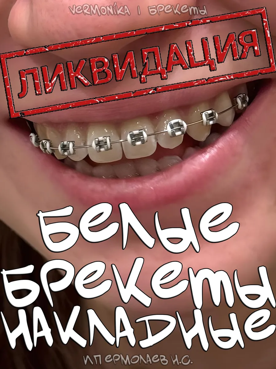 Брекеты накладные...