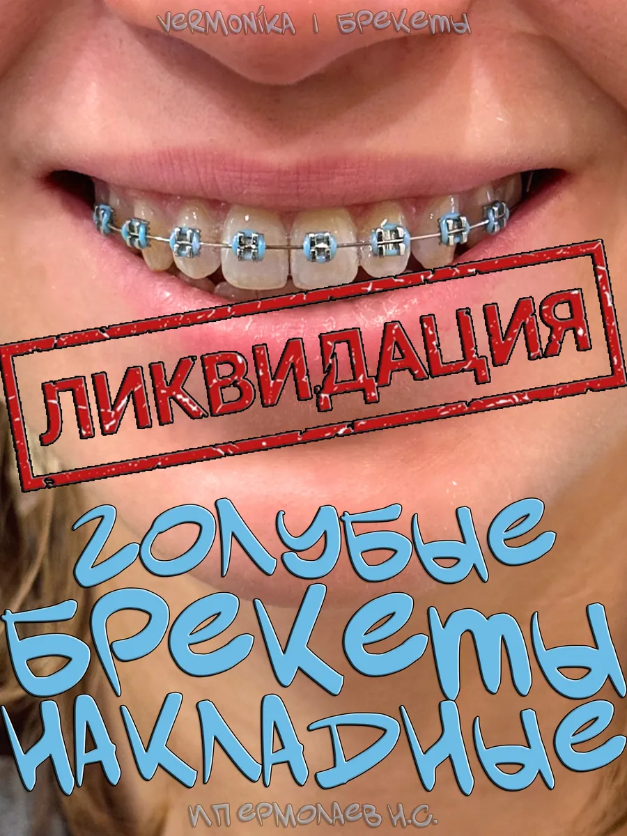 Брекеты накладные...