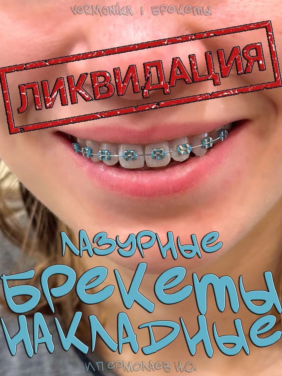 Брекеты накладные...